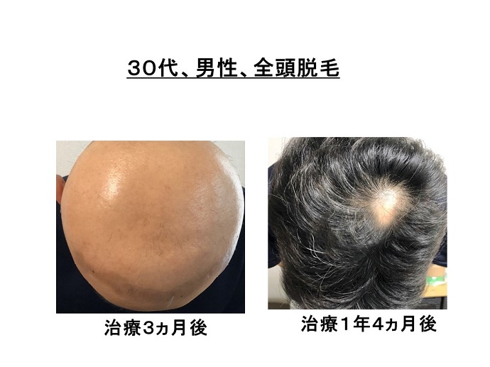 円形脱毛症　病院